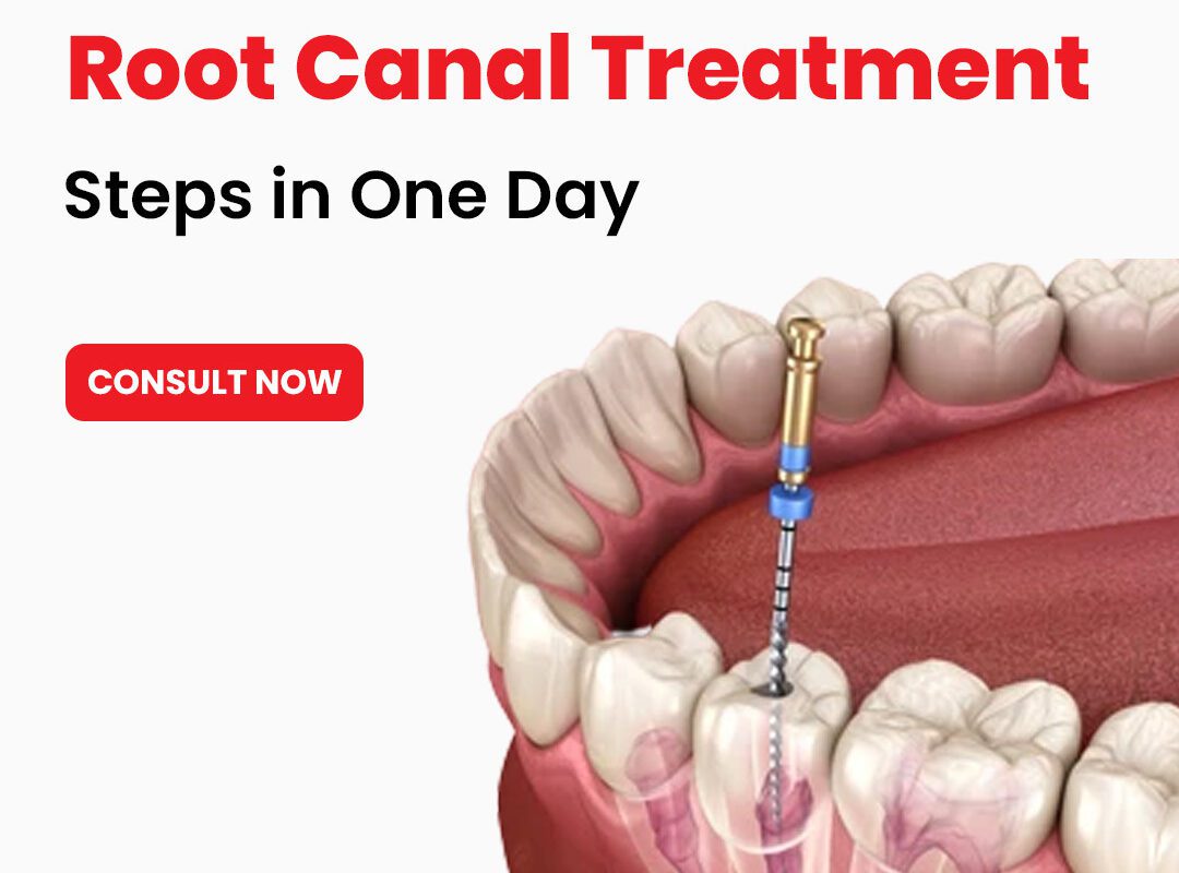 Single Sitting Root Canal