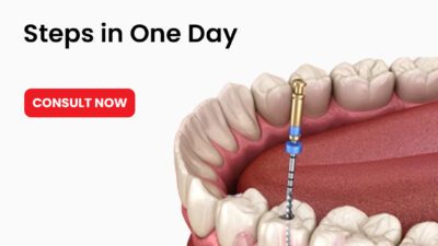 Single Sitting Root Canal