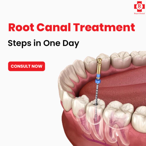Single Sitting Root Canal Cap