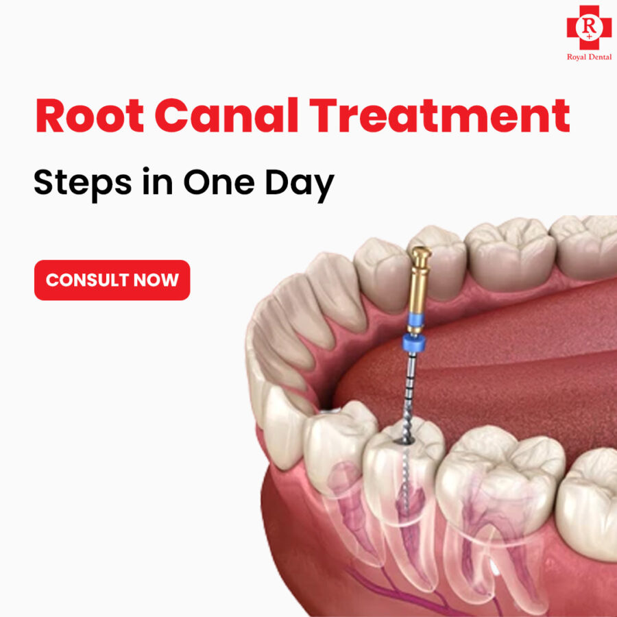 Single Sitting Root Canal