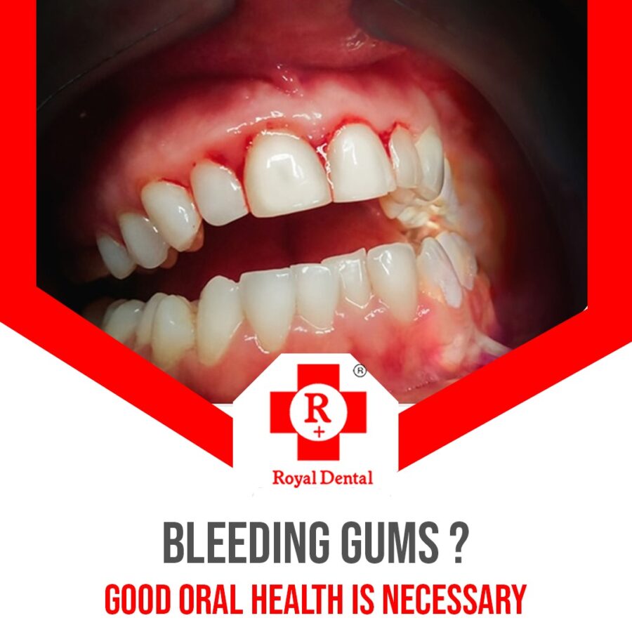 bleeding gums periodontitis