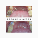 Do All Teeth Cavities need to a Filling? Royal Dental Clinics Prevent Dental Caries - Teeth Cavities