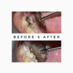 Do All Teeth Cavities need to a Filling? Royal Dental Clinics Dental Cavity Filling in Time