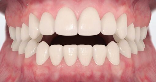 Bite Alignment Procedures Royal Dental Clinics open bite