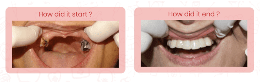 Full Mouth Rehabilitation in Mumbai Royal Dental Clinics full mouth rehabilitation