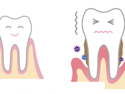 tooth mobility