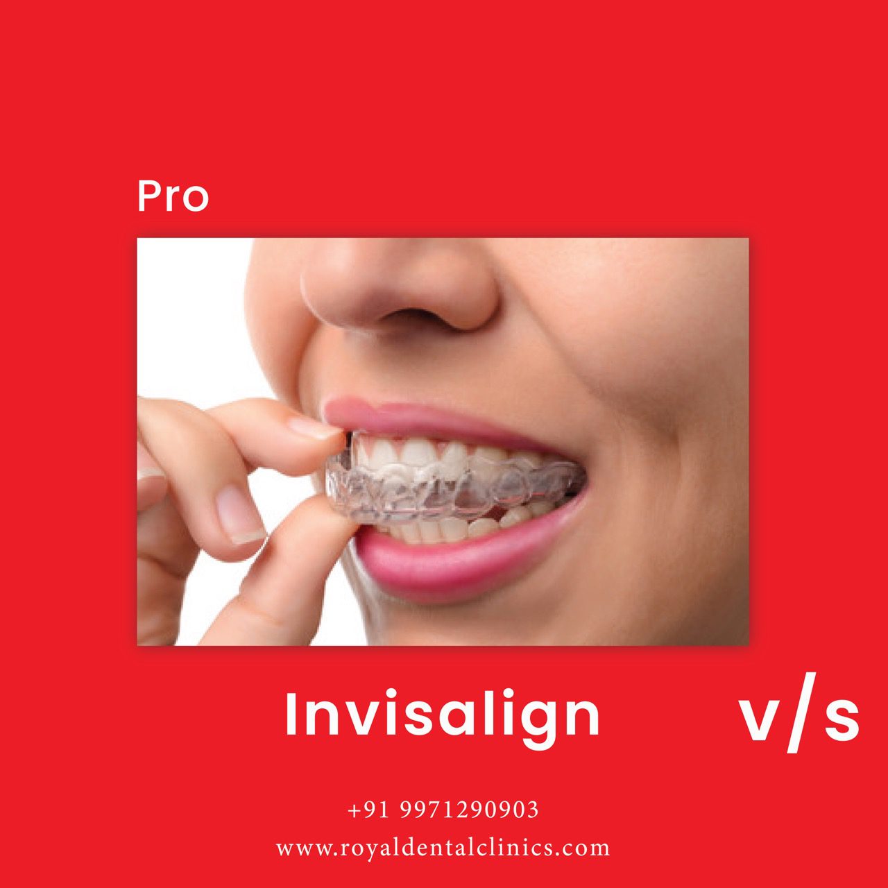 Invisalign braces - Clear Aligners