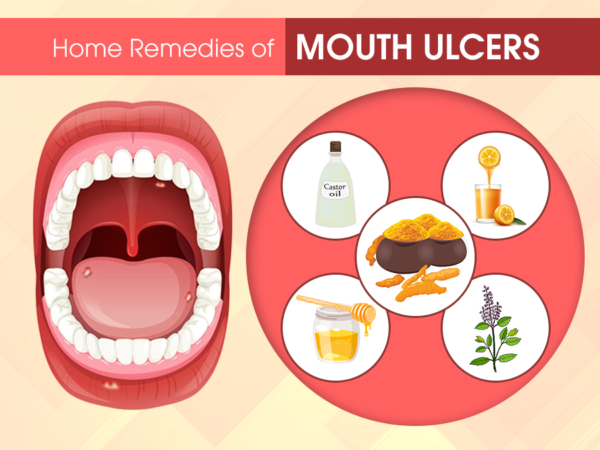 home remedies for oral ulcers