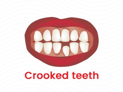 crooked teeth