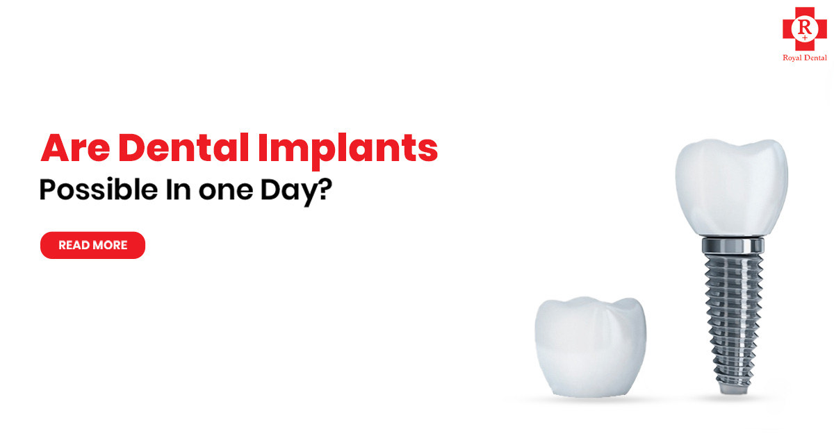 dental implants in one day reviews