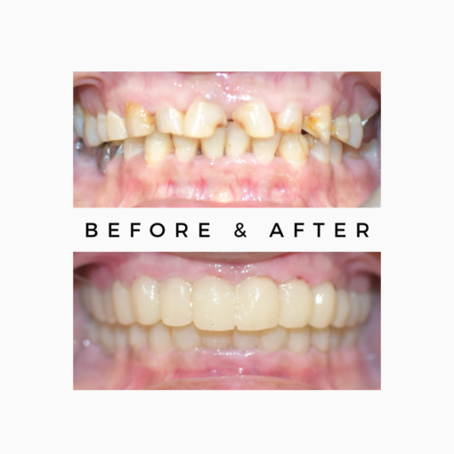 How is an Implant attached to the Crown? Royal Dental Clinics spaces between front teeth