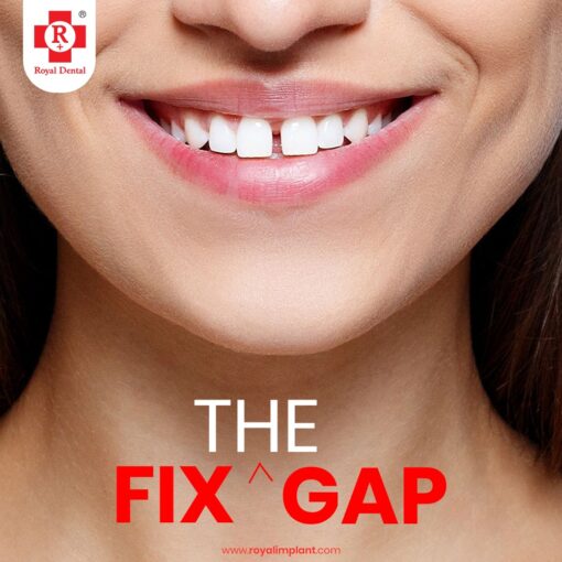 fix the gap diastema
