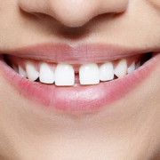 gap in teeth adolescence