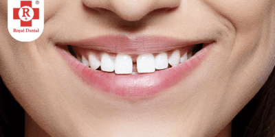 gap in teeth adolescence