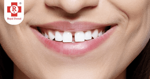 gap in teeth adolescence