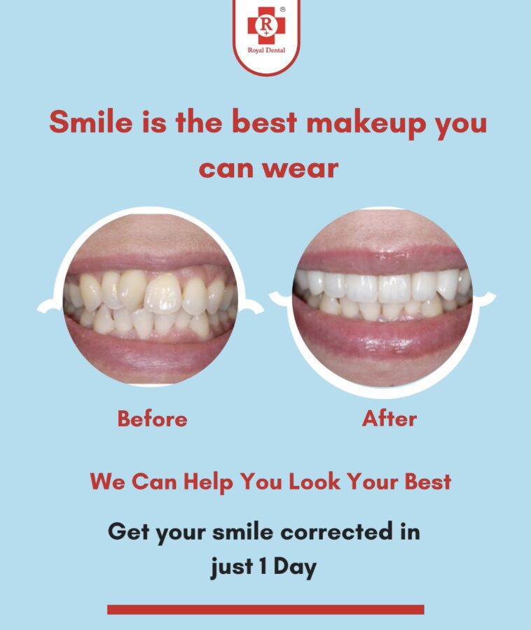 Braces, Invisalign, Smile Makeover: Correct Your Smile? Royal Dental Clinics crooked teeth correction - correct your smile