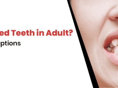 Orthodontic Braces vs Same-Day Cosmetic Treatment: Which Is Better? Royal Dental Clinics Same Day Cosmetic Treatment for Teeth Crowding