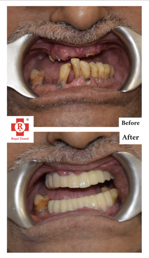 teeth-mobility-gum-disease