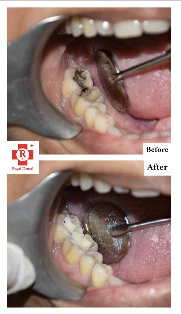 Cavity Filling for tooth decay