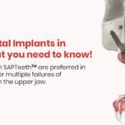 zygomatic implant in one day