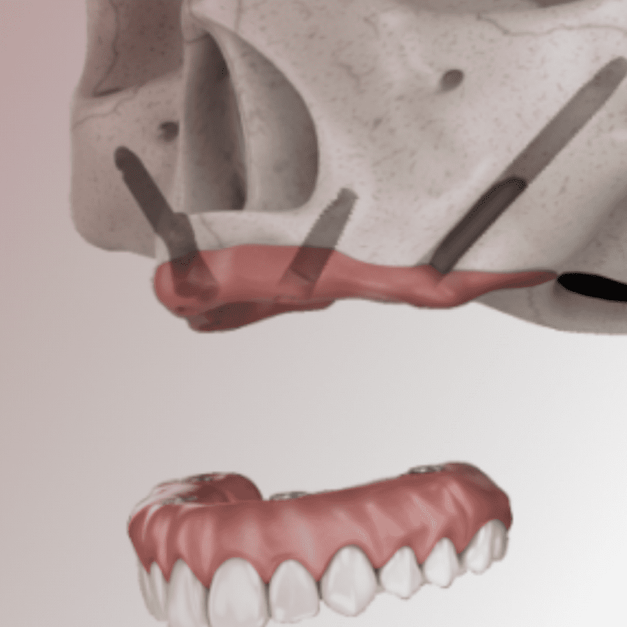 zygomatic implant denture