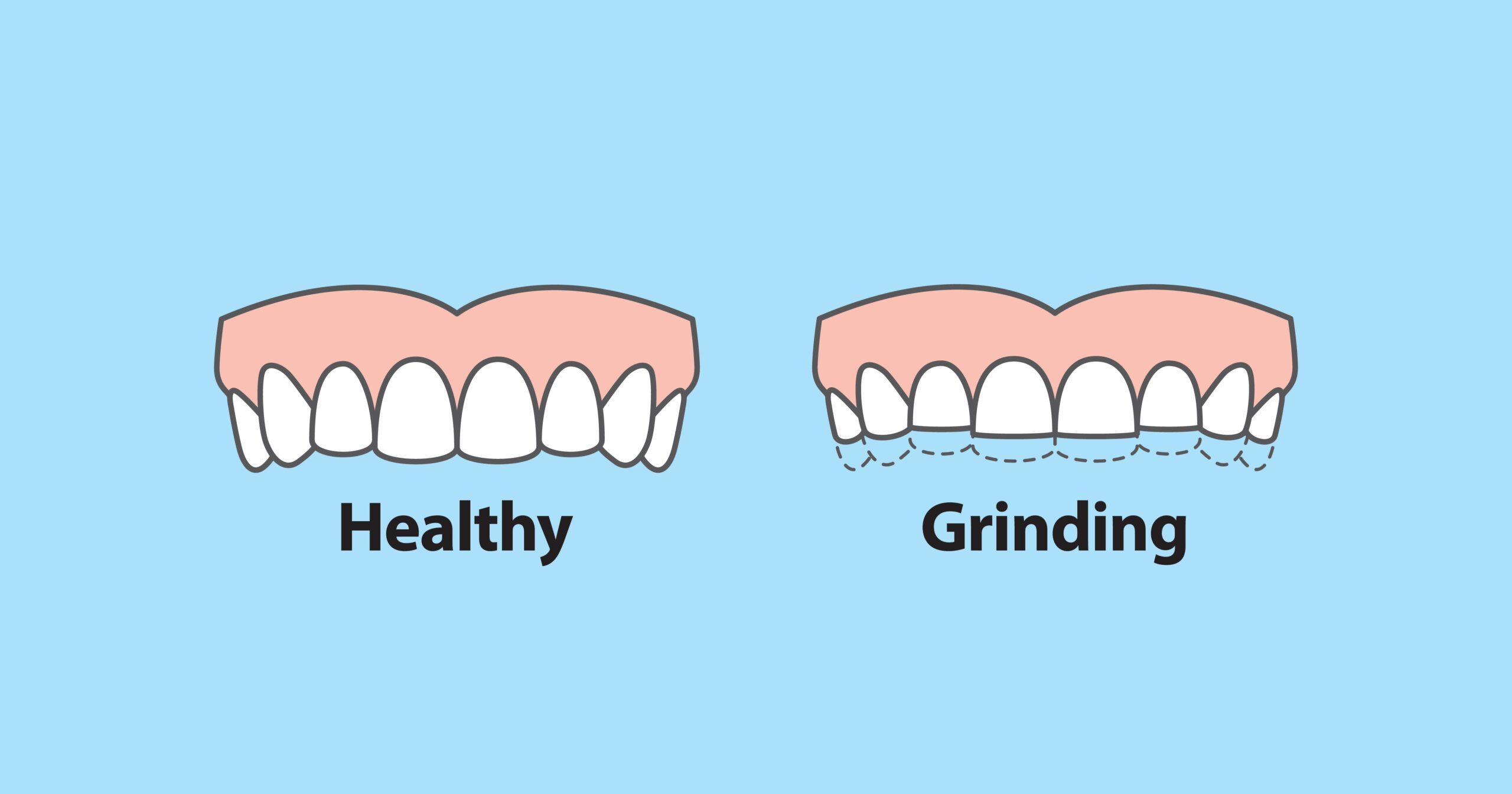night grinding vs healthy teeth
