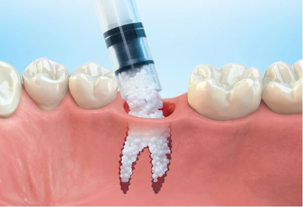 no bone dental implant