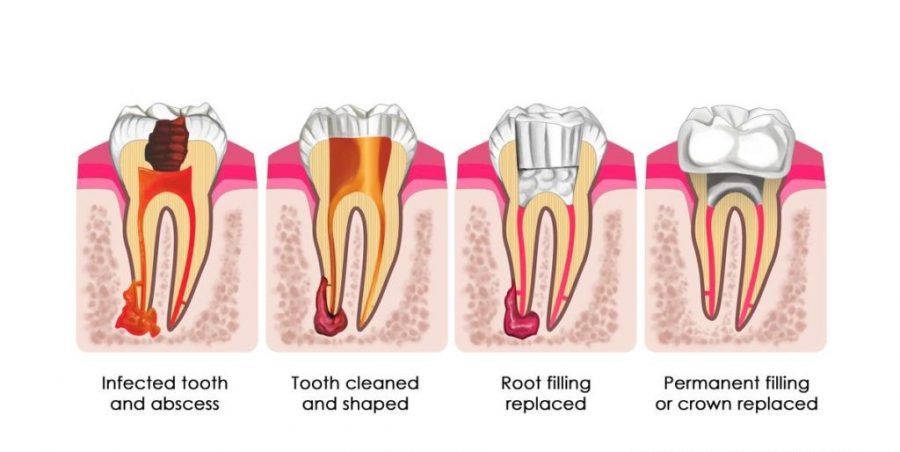 root canal treatment endodontics