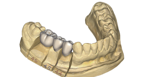 artificial dental crowns SAPTeeth