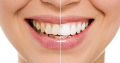 tooth whitening treatment