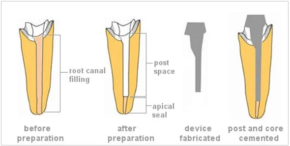 post_and_core_procedure.jpg