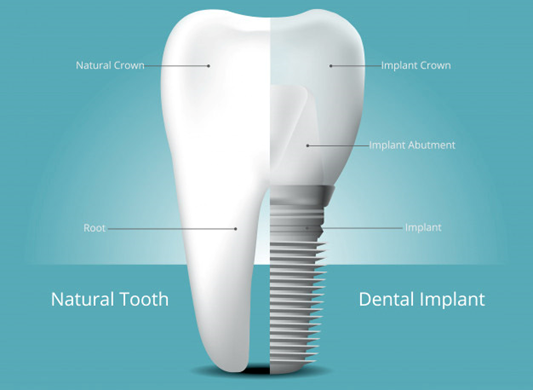 Natural tooth vs dental implant