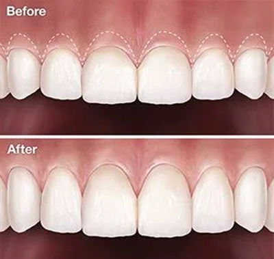 gummy smile - crown lengthening