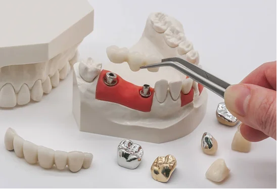 SAPTeeth dental crown