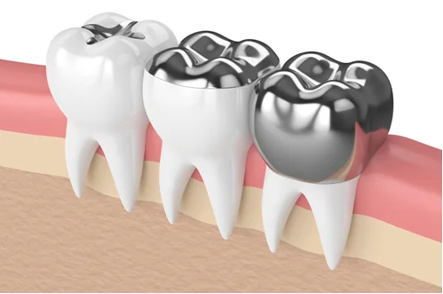 Ceramic dental crown technology