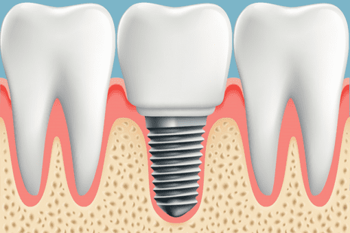 dental implant surgery