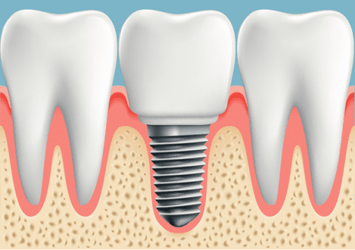 dental implant surgery - Are dental implants successful at age 30?