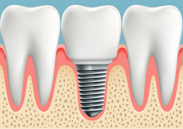 dental implant surgery - Are dental implants successful at age 30?
