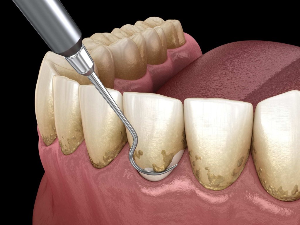 dental tartar plaque