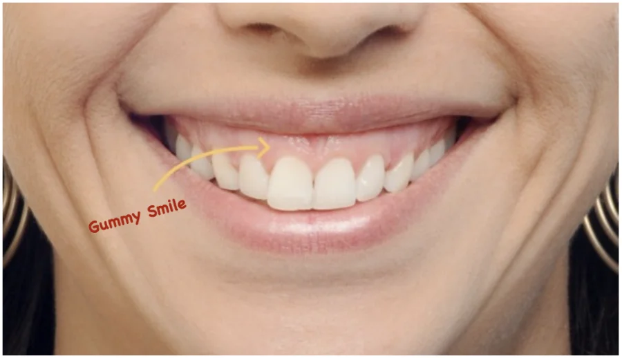 gummy smile