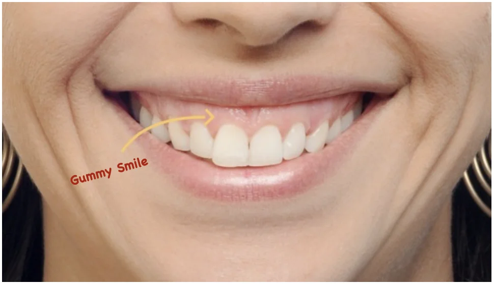 gummy smile