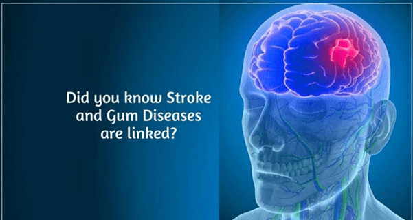 Impact of Brain Stroke on Oral Health Royal Dental Clinics Relation Between Brain Stroke And Oral Health