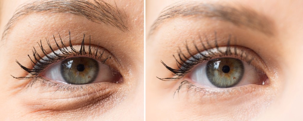 get-amazing-upper-eyelid-sagging-today-royal-dental-clinics-blog