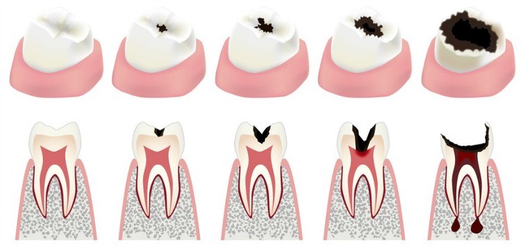 dental filling cavity