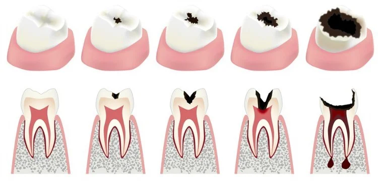 dental filling cavity treatment