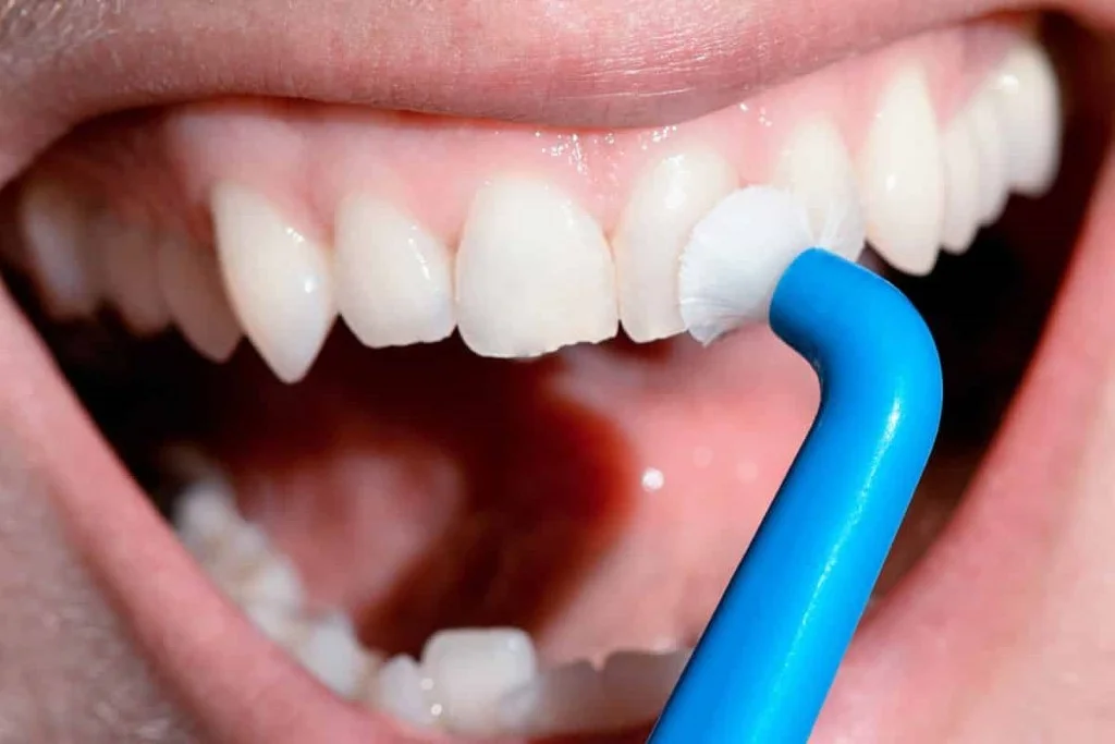 teeth scaling
