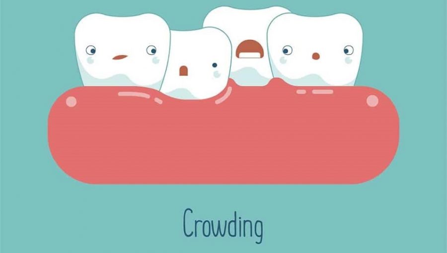 teeth crowding, Orthodontic treatment