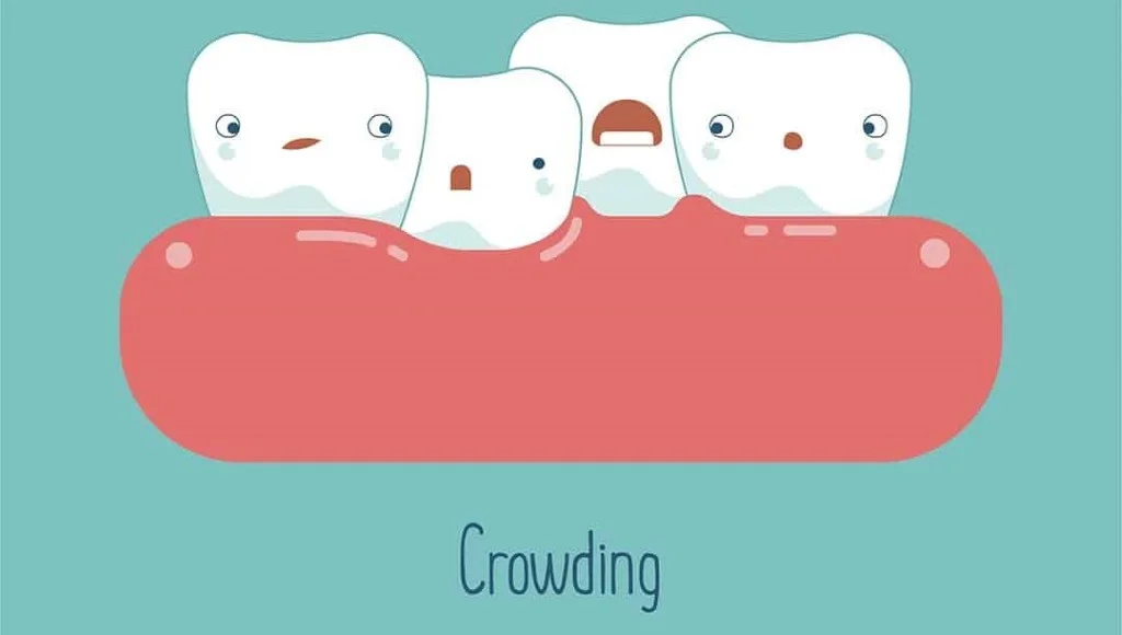 Cosmetic Correction for Teeth Crowding