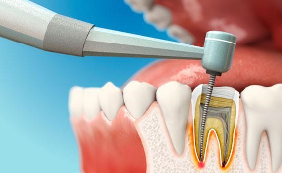 root canal treatment, Difference between Inlay and Onlay