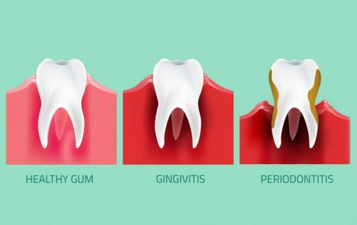 heathy vs gingivitis gums